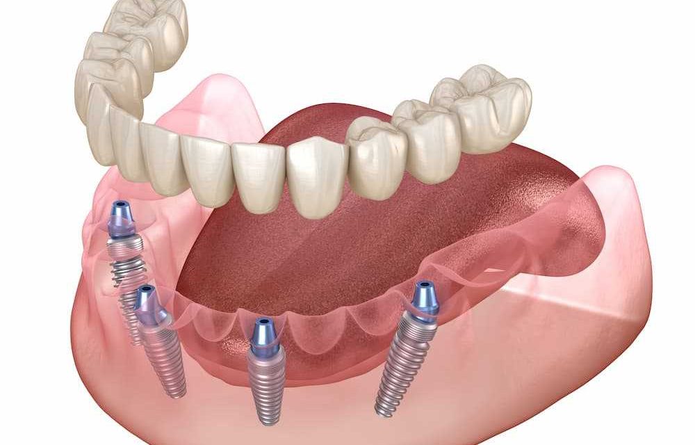 WHAT IS A FULL DENTURE PROSTHESIS (PROSTHETIC TEETH)?
