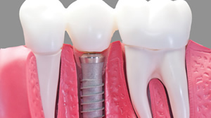 https://yigitdis.com/en/wp-content/uploads/2023/04/implant4.jpg